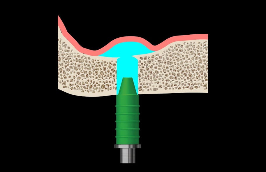 Figure 3: Hydraulic sinus lift technique. Only saline is used to gently lift the sinus membrane. The bone graft will subsequently be inserted into the sinus using a noninvasive funnel.