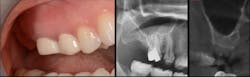 Figure 4: The patient presented with a missing no. 2. The residual alveolar bone height was 5 mm; therefore, a sinus lift was required. Figure 4: The patient presented with a missing no. 2. The residual alveolar bone height was 5 mm; therefore, a sinus lift was required.