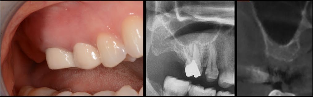 Figure 4: The patient presented with a missing no. 2. The residual alveolar bone height was 5 mm; therefore, a sinus lift was required.