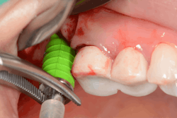 Figure 5: A hydraulic crestal sinus lift was performed to augment bone instead of a traditional osteotome crestal sinus lift. No bone graft material was inserted, as the sinus was narrow and the required amount of augmentation was not extensive. Figure 5: A hydraulic crestal sinus lift was performed to augment bone instead of a traditional osteotome crestal sinus lift. No bone graft material was inserted, as the sinus was narrow and the required amount of augmentation was not extensive.