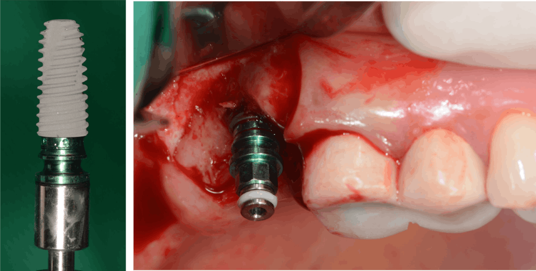 Figure 6: An implant was installed in the correct position, angulation, and depth.