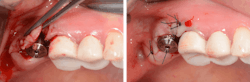 Figure 7: A healing abutment was attached at the same time as the primary stability was sufficient. The flap was sutured. Figure 7: A healing abutment was attached at the same time as the primary stability was sufficient. The flap was sutured.