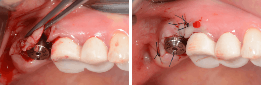 Figure 7: A healing abutment was attached at the same time as the primary stability was sufficient. The flap was sutured.