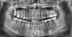 Figure 8: Immediate postoperative panoramic radiograph illustrates the implant was installed in the desired position, angulation, and depth.