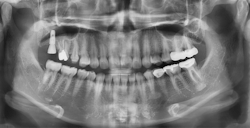 Figure 8: Immediate postoperative panoramic radiograph illustrates the implant was installed in the desired position, angulation, and depth. Figure 8: Immediate postoperative panoramic radiograph illustrates the implant was installed in the desired position, angulation, and depth.