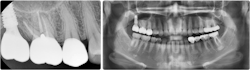 Figure 9: The implant was restored after six months. Note the PA and pan. Figure 9: The implant was restored after six months. Note the PA and pan.
