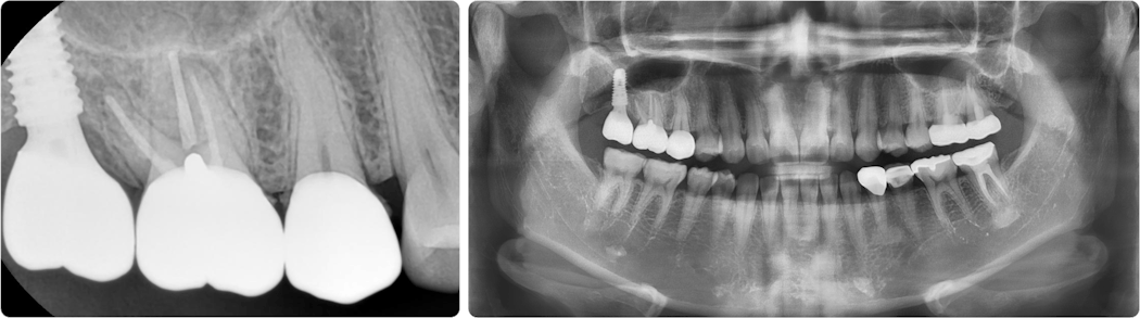 Figure 9: The implant was restored after six months. Note the PA and pan.
