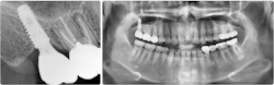Figure 10: Follow-up at two years and 10 months. The bone level is stable. Note the successful sinus bone augmentation radiographically. Figure 10: Follow-up at two years and 10 months. The bone level is stable. Note the successful sinus bone augmentation radiographically.