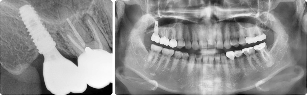 Figure 10: Follow-up at two years and 10 months. The bone level is stable. Note the successful sinus bone augmentation radiographically.