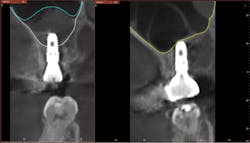 Figure 11: Comparison of immediate postoperative CBCT (left) and CBCT at two years and 10 months (right). The white line represents the original level of the sinus floor. The blue line represents the hydraulically lifted level of the sinus floor. The yellow line represents the final augmentation of the bone, which completely envelops the dental implant. Figure 11: Comparison of immediate postoperative CBCT (left) and CBCT at two years and 10 months (right). The white line represents the original level of the sinus floor. The blue line represents the hydraulically lifted level of the sinus floor. The yellow line represents the final augmentation of the bone, which completely envelops the dental implant.