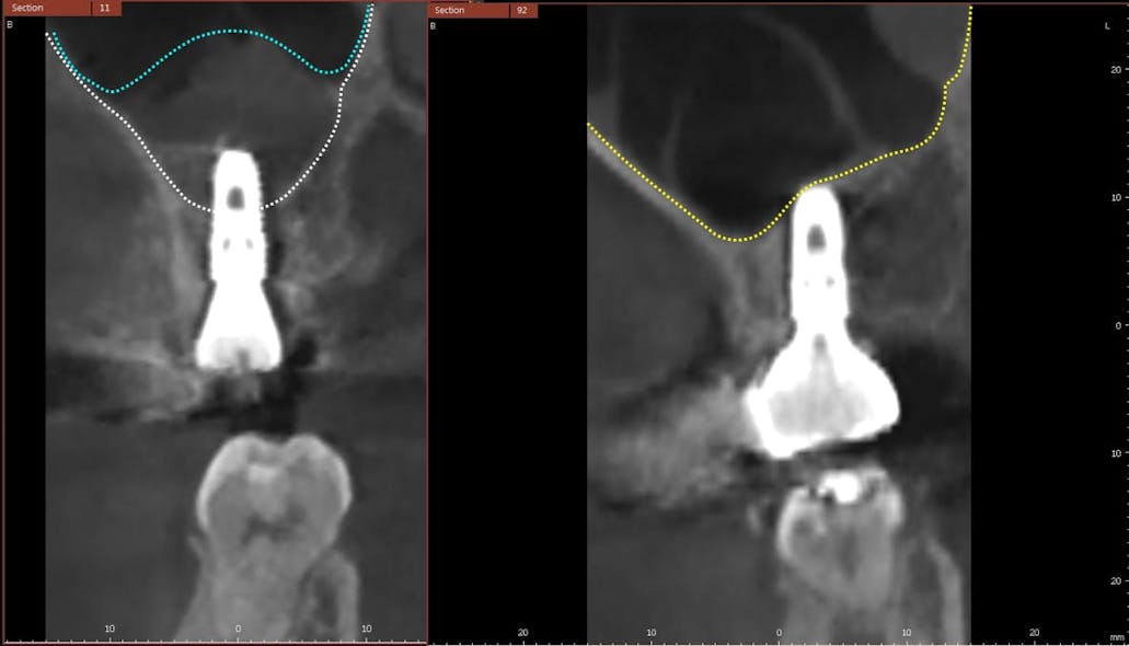 Figure 11: Comparison of immediate postoperative CBCT (left) and CBCT at two years and 10 months (right). The white line represents the original level of the sinus floor. The blue line represents the hydraulically lifted level of the sinus floor. The yellow line represents the final augmentation of the bone, which completely envelops the dental implant.