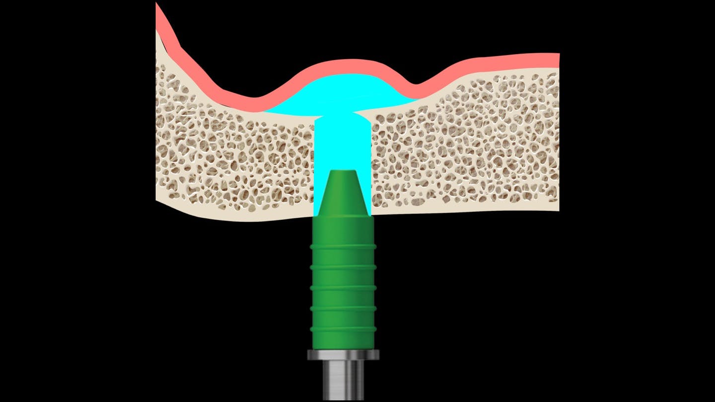 primary-hydraulic-sinus-lift