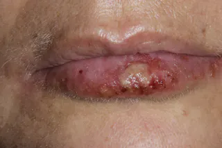 bpc 157 herpes Cold sore treatment: 4 methods to improve healing