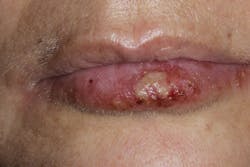 Figure 1: Herpes labialis (cold sore) Figure 1: Herpes labialis (cold sore)