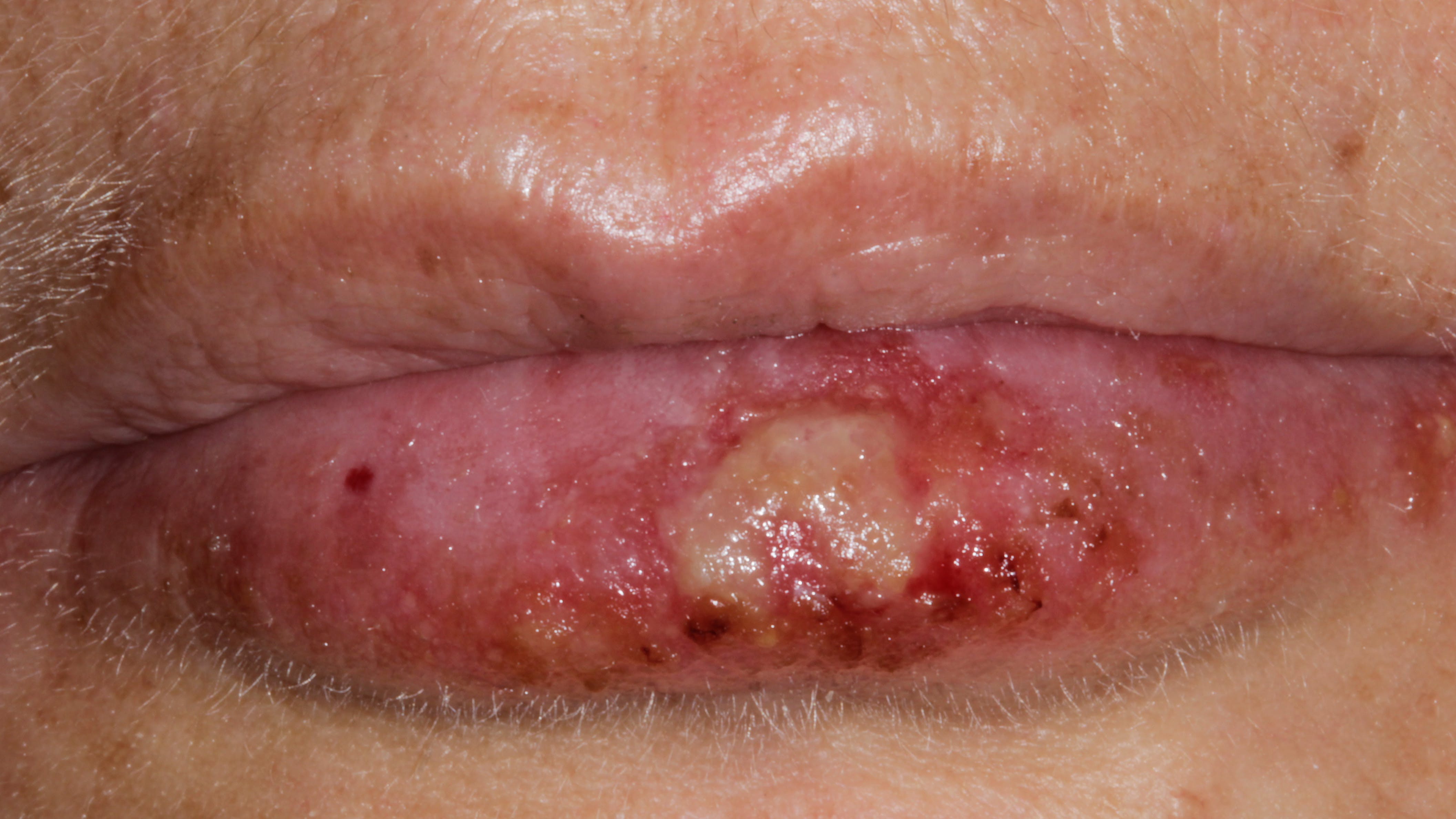 6596df21b64ad8001e0158e8 Primarycoldsores