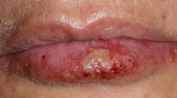 cold-sores cold-sores