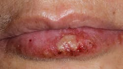 6596df21b64ad8001e0158e8 Primarycoldsores 6596df21b64ad8001e0158e8 Primarycoldsores