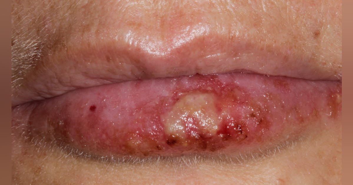 bpc 157 herpes Dr. Kyle Gillett | Do you have herpes? Probably. Most individuals are infected by a herpesvirus. And most initial outbreaks are actually non primary Risk of Herpes Zoster in