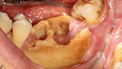 mronj-osteonecrosis-dentistry