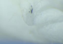 Figure 3d: Representative photograph at magnification of material found inside the implant