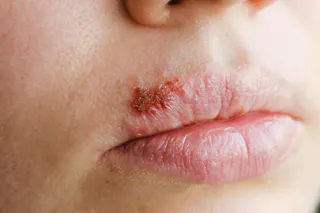 glutathione herpes virus Treating cold sores in two days and canker sores through glutathione  antioxidation