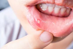 Figure 2: Canker sore Figure 2: Canker sore