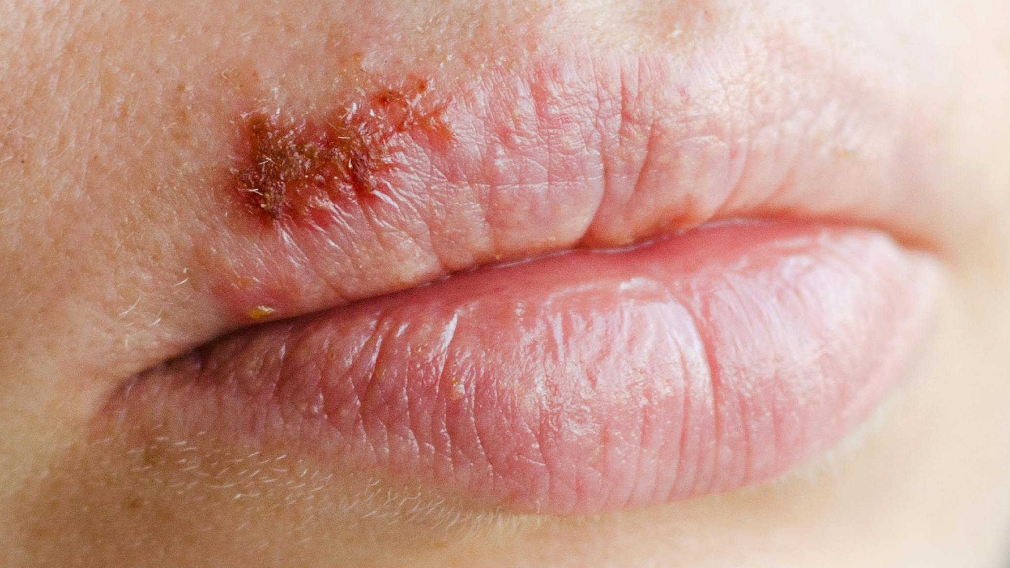 primary-herpes-lesion