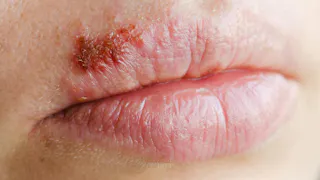 ghk cu herpes A Dermatologist's Take on the Copper Peptide (GHK-Cu) Trend Treating cold sores in two