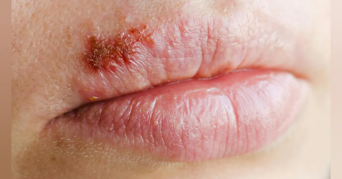 Treating cold sores in two days and canker sores through glutathione antioxidation | Perio Implant Advisory Treating cold sores in two days and canker sores through glutathione antioxidation | Perio Implant Advisory