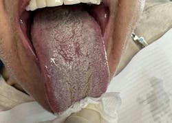 Figure 1: Oral thrush Figure 1: Oral thrush