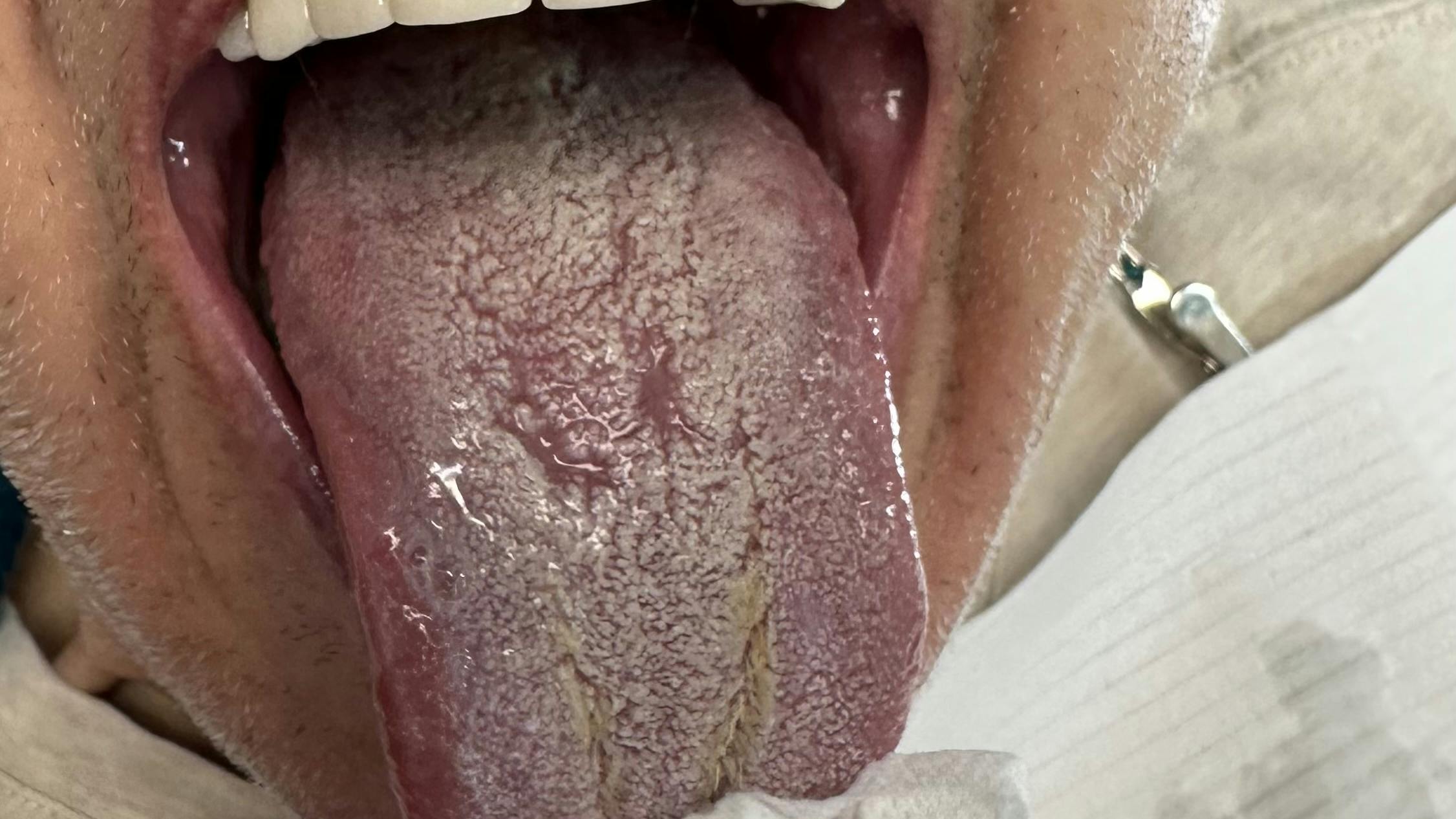 oral thrush