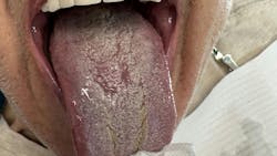 oral thrush oral thrush