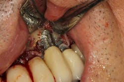 Figure 2: Osteoplasty Figure 2: Osteoplasty