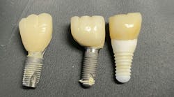dental implant metallosis dental implant metallosis
