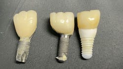 dental implant metallosis dental implant metallosis