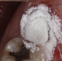 Polyox bandage prevents dry socket Polyox bandage prevents dry socket