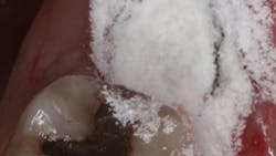 Polyox bandage to prevent dry socket Polyox bandage to prevent dry socket