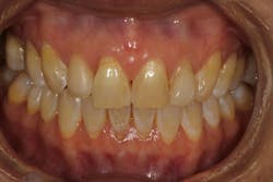 Pinhole Surgical Technique with platelet-rich fibrin to enhance soft-tissue grafting Pinhole Surgical Technique with platelet-rich fibrin to enhance soft-tissue grafting