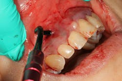 Pinhole Surgical Technique with platelet-rich fibrin to enhance soft-tissue grafting Pinhole Surgical Technique with platelet-rich fibrin to enhance soft-tissue grafting
