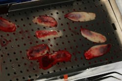 Pinhole Surgical Technique with platelet-rich fibrin to enhance soft-tissue grafting Pinhole Surgical Technique with platelet-rich fibrin to enhance soft-tissue grafting