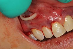 Pinhole Surgical Technique with platelet-rich fibrin to enhance soft-tissue grafting Pinhole Surgical Technique with platelet-rich fibrin to enhance soft-tissue grafting