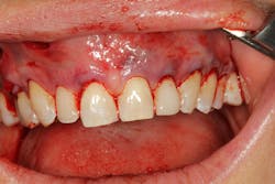 Pinhole Surgical Technique with platelet-rich fibrin to enhance soft-tissue grafting Pinhole Surgical Technique with platelet-rich fibrin to enhance soft-tissue grafting