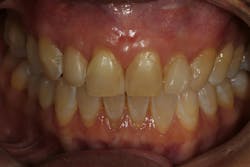 Pinhole Surgical Technique with platelet-rich fibrin to enhance soft-tissue grafting Pinhole Surgical Technique with platelet-rich fibrin to enhance soft-tissue grafting