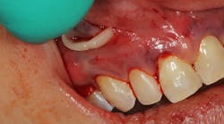 Pinhole Surgical Technique with platelet-rich fibrin to enhance soft-tissue grafting Pinhole Surgical Technique with platelet-rich fibrin to enhance soft-tissue grafting
