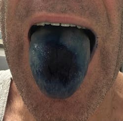 Blue tongue from methylene blue Blue tongue from methylene blue