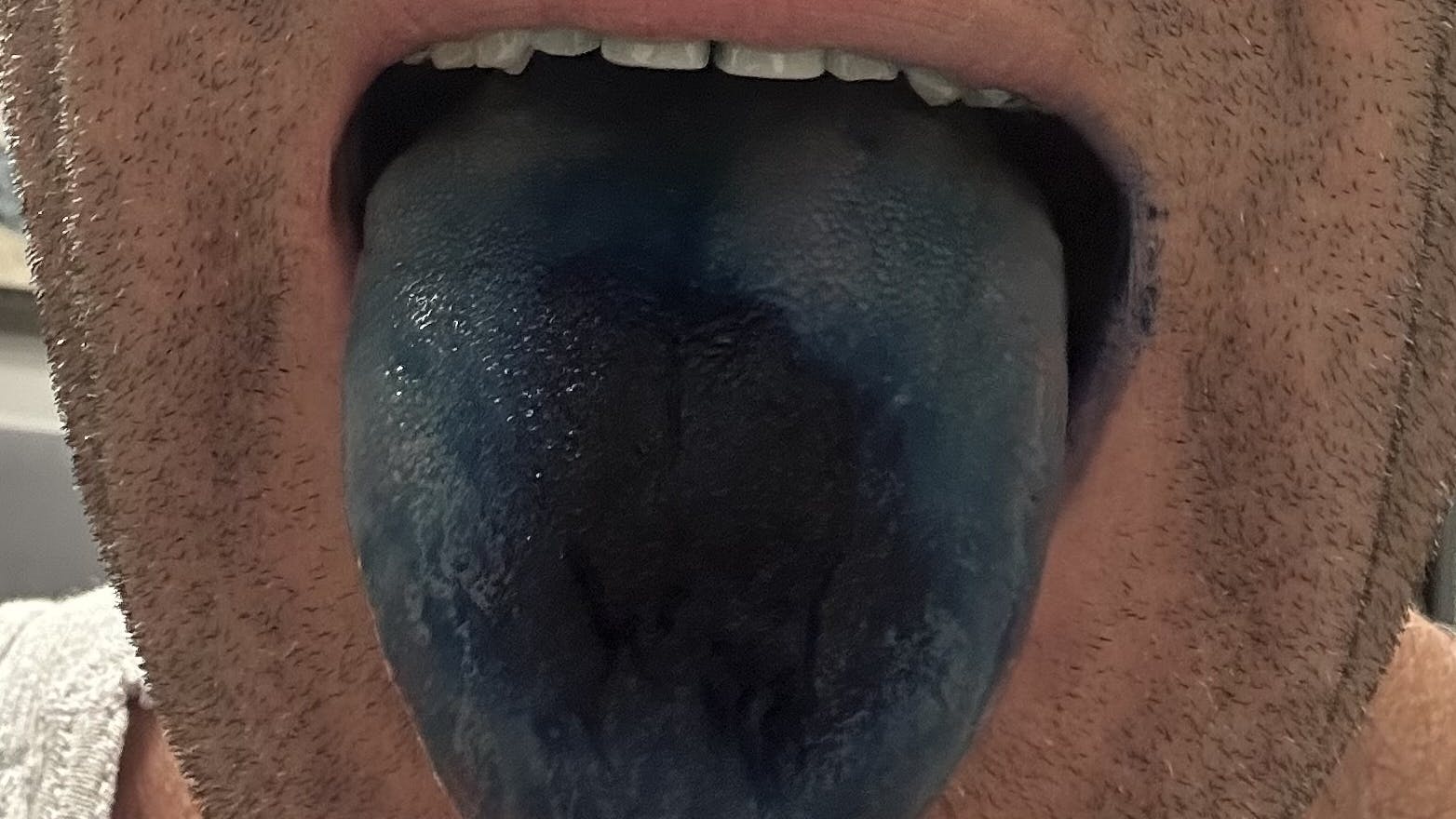 blue tongue from methylene blue