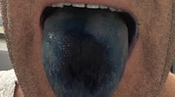 blue tongue from methylene blue blue tongue from methylene blue