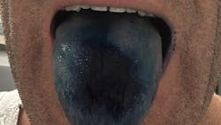 blue tongue from methylene blue blue tongue from methylene blue