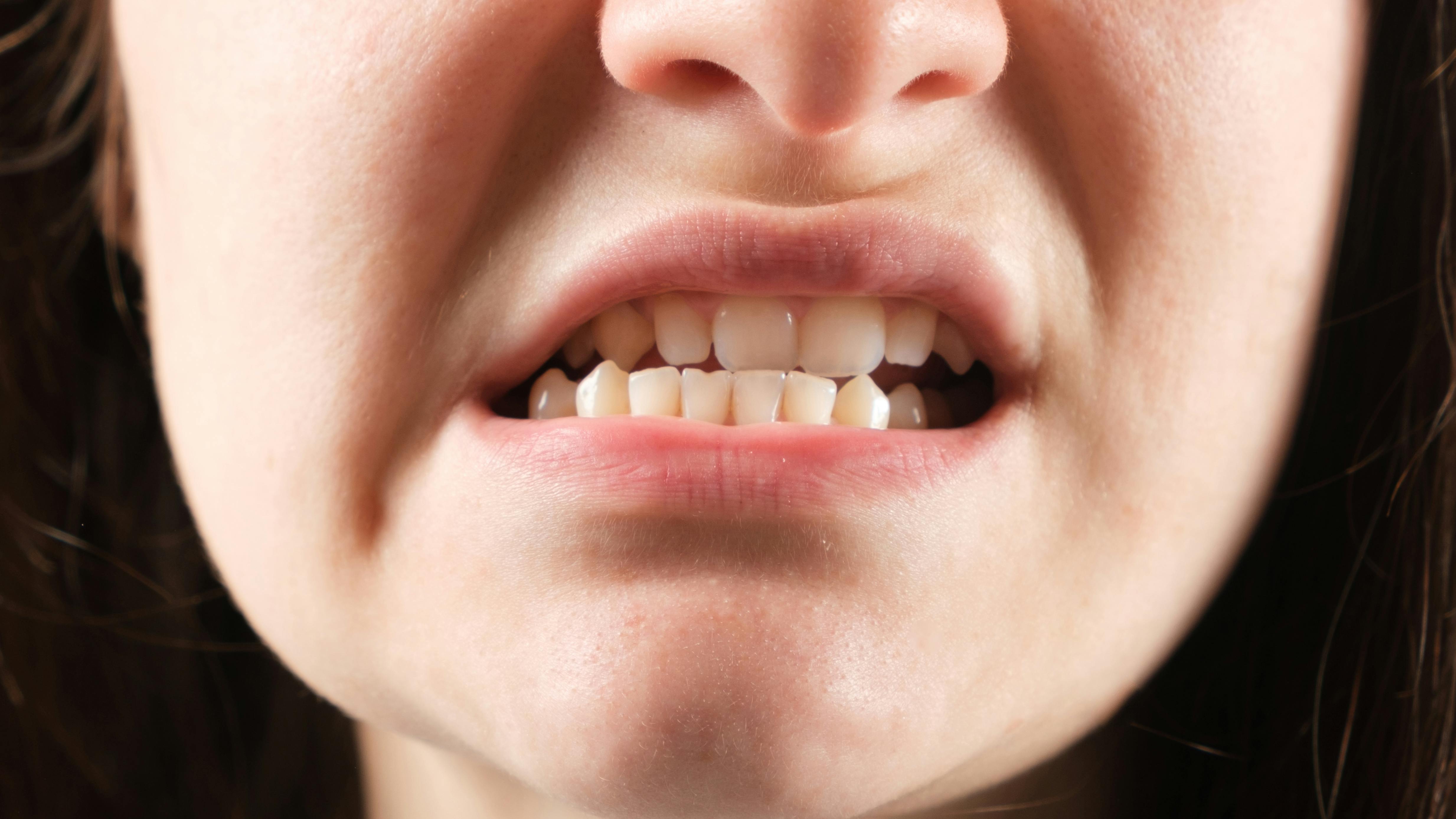 woman grinding her teeth