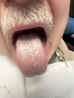 Figure 1: Clinical appearance of tongue coating and bacterial buildup contributing to halitosis Figure 1: Clinical appearance of tongue coating and bacterial buildup contributing to halitosis